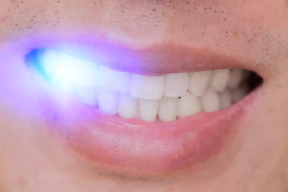Whitening Techniques