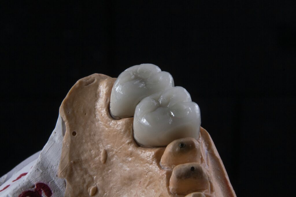 dental crown issues