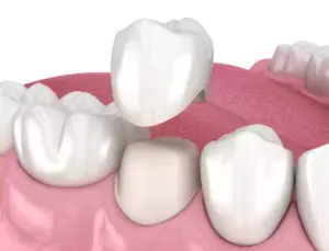 how long do dental crowns last